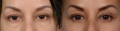 Blepharoplasty (Eyelid Surgery) Before & After Gallery - Patient 165961 - Image 1