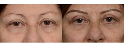 Blepharoplasty (Eyelid Surgery) Before & After Gallery - Patient 625243 - Image 1