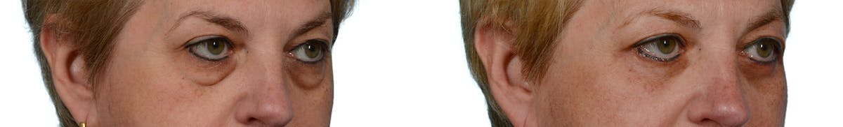 Blepharoplasty (Eyelid Surgery) Before & After Gallery - Patient 231657 - Image 2