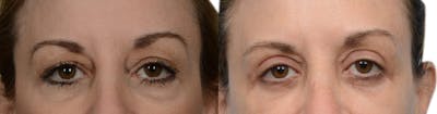 Blepharoplasty (Eyelid Surgery) Before & After Gallery - Patient 100910 - Image 1