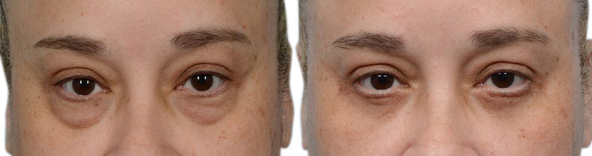 Blepharoplasty (Eyelid Surgery) Before & After Gallery - Patient 167516 - Image 1