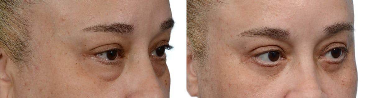 Blepharoplasty (Eyelid Surgery) Before & After Gallery - Patient 167516 - Image 2