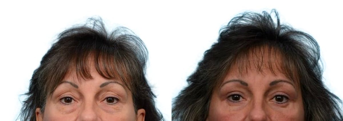 Blepharoplasty (Eyelid Surgery) Before & After Gallery - Patient 847568 - Image 1