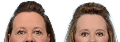 Blepharoplasty (Eyelid Surgery) Before & After Gallery - Patient 411628 - Image 1