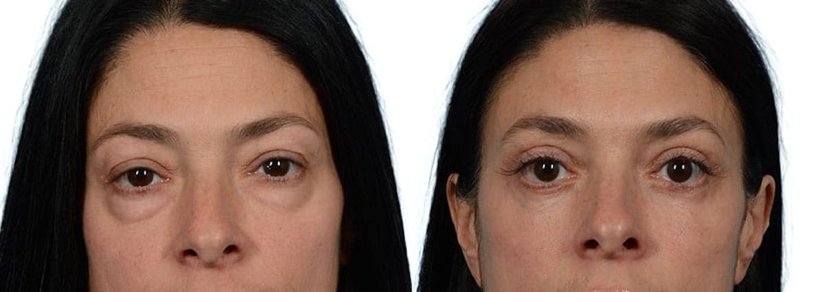 Blepharoplasty (Eyelid Surgery) Before & After Gallery - Patient 255960 - Image 1