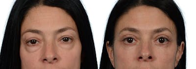 Blepharoplasty (Eyelid Surgery) Before & After Gallery - Patient 255960 - Image 1