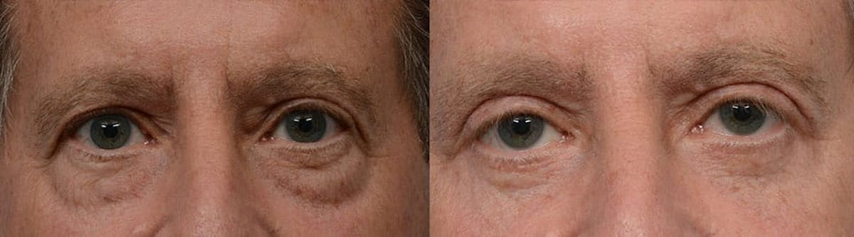 Blepharoplasty (Eyelid Surgery) Before & After Gallery - Patient 151184 - Image 1