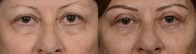 Blepharoplasty (Eyelid Surgery) Before & After Gallery - Patient 236405 - Image 1