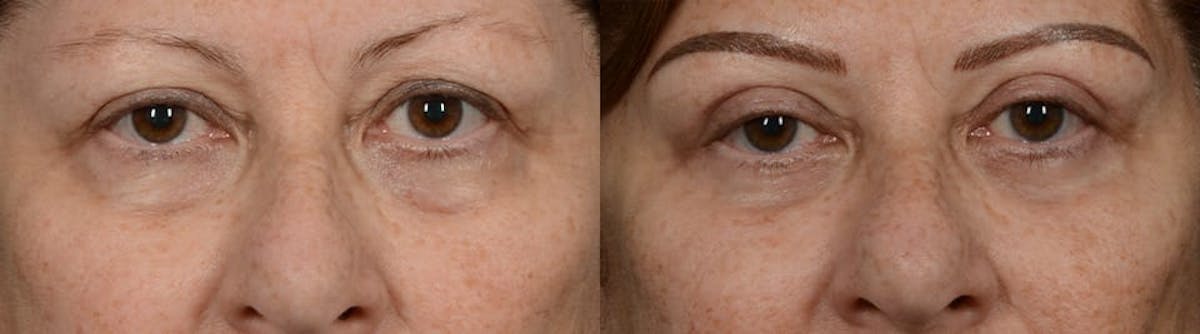 Blepharoplasty (Eyelid Surgery) Before & After Gallery - Patient 236405 - Image 1