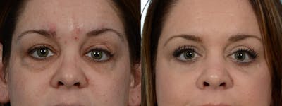 Blepharoplasty (Eyelid Surgery) Before & After Gallery - Patient 417422 - Image 1