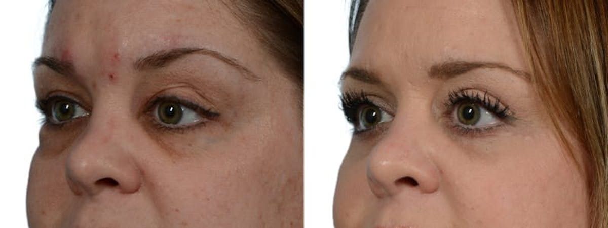 Blepharoplasty (Eyelid Surgery) Before & After Gallery - Patient 417422 - Image 2