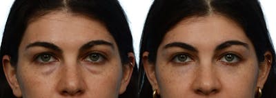 Blepharoplasty (Eyelid Surgery) Before & After Gallery - Patient 393188 - Image 1