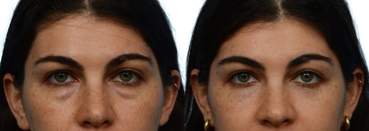 Blepharoplasty (Eyelid Surgery) Before & After Gallery - Patient 393188 - Image 1