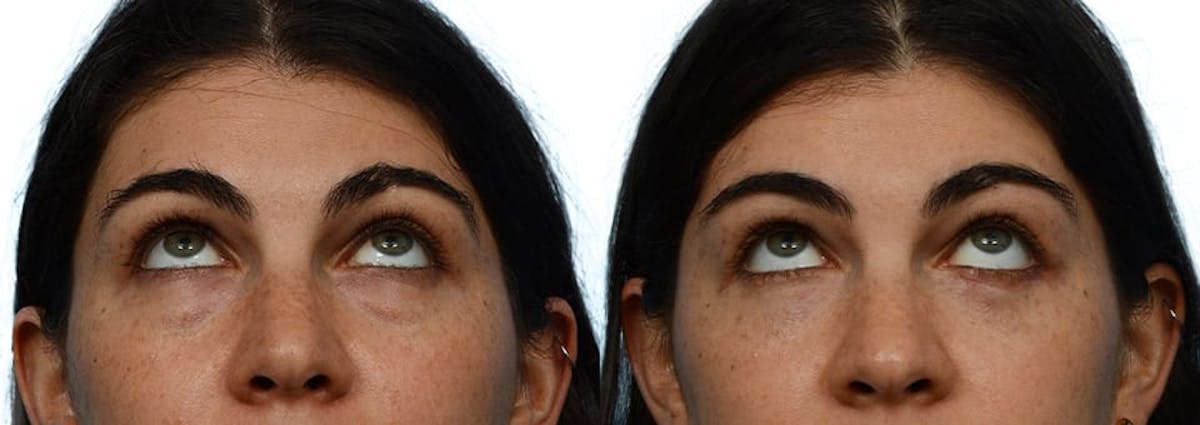 Blepharoplasty (Eyelid Surgery) Before & After Gallery - Patient 393188 - Image 2