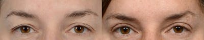 Blepharoplasty (Eyelid Surgery) Before & After Gallery - Patient 782309 - Image 1