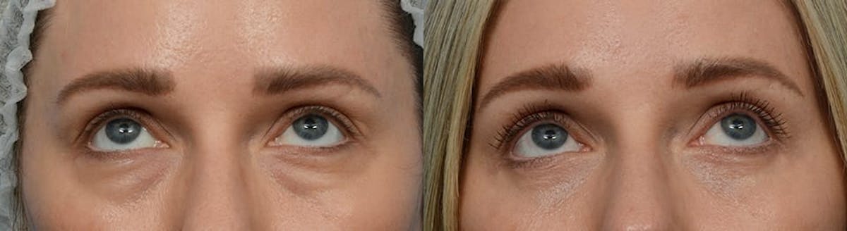 Blepharoplasty (Eyelid Surgery) Before & After Gallery - Patient 299794 - Image 1