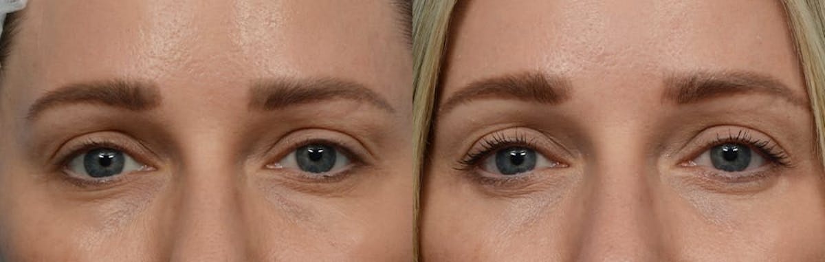 Blepharoplasty (Eyelid Surgery) Before & After Gallery - Patient 299794 - Image 2