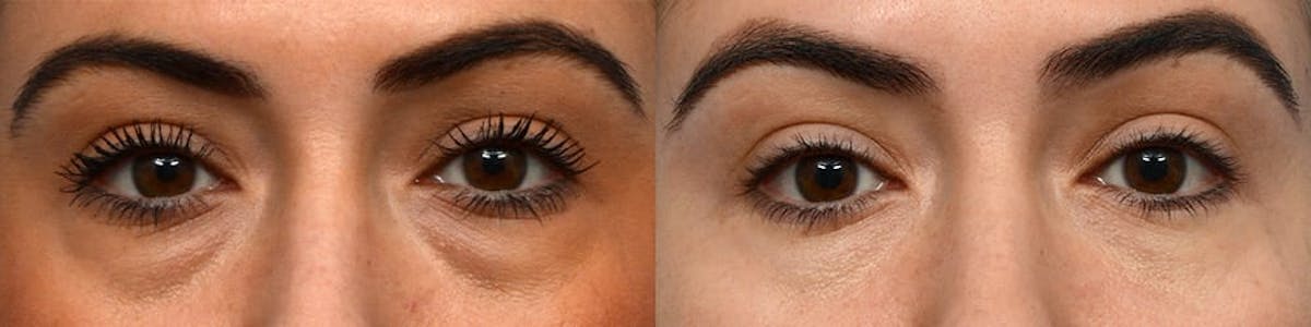 Blepharoplasty (Eyelid Surgery) Before & After Gallery - Patient 198265 - Image 1