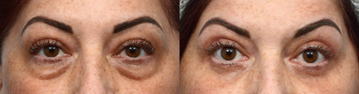 Blepharoplasty (Eyelid Surgery) Before & After Gallery - Patient 385058 - Image 1