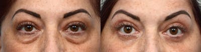 Blepharoplasty (Eyelid Surgery) Before & After Gallery - Patient 385058 - Image 1