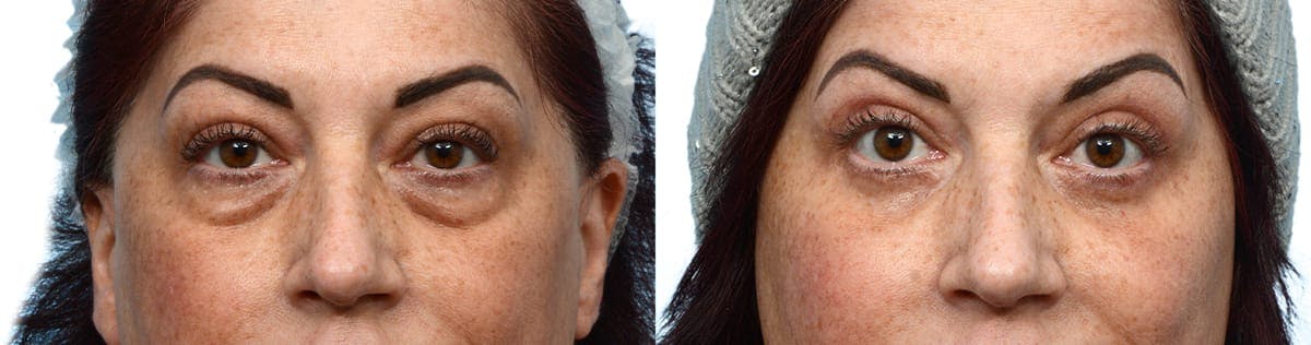Blepharoplasty (Eyelid Surgery) Before & After Gallery - Patient 385058 - Image 2