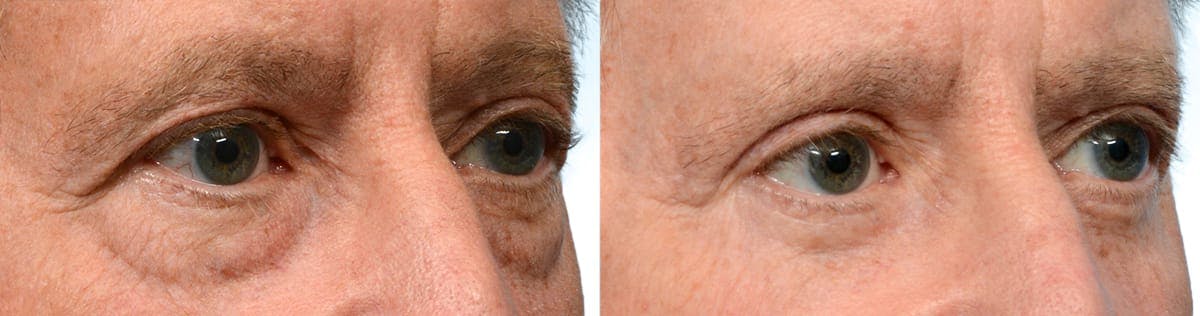 Blepharoplasty (Eyelid Surgery) Before & After Gallery - Patient 236860 - Image 2