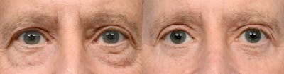 Blepharoplasty (Eyelid Surgery) Before & After Gallery - Patient 236860 - Image 1