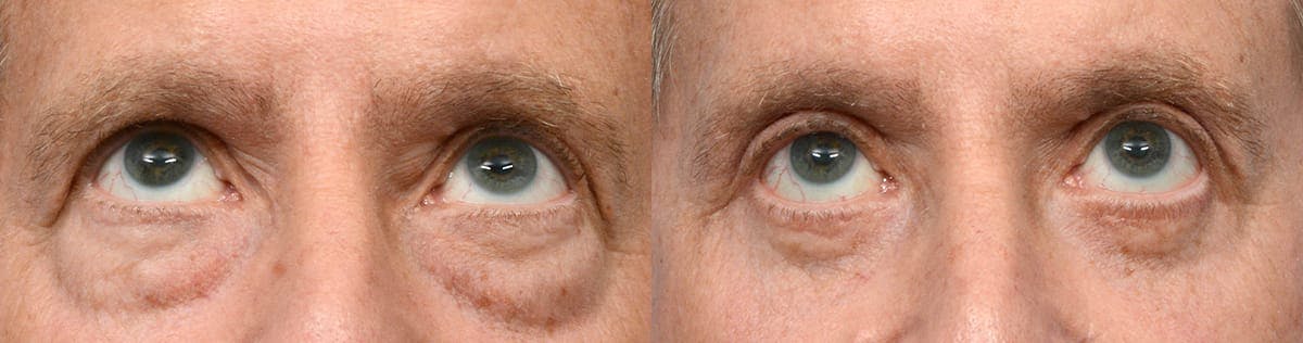Blepharoplasty (Eyelid Surgery) Before & After Gallery - Patient 236860 - Image 3