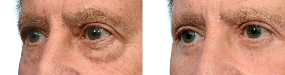 Blepharoplasty (Eyelid Surgery) Before & After Gallery - Patient 236860 - Image 4