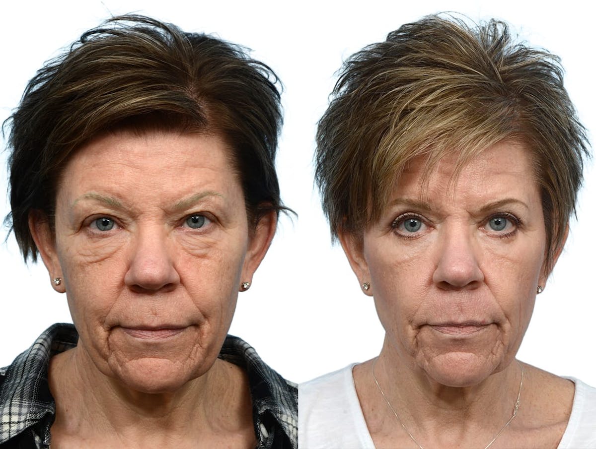 Blepharoplasty (Eyelid Surgery) Before & After Gallery - Patient 402903 - Image 1