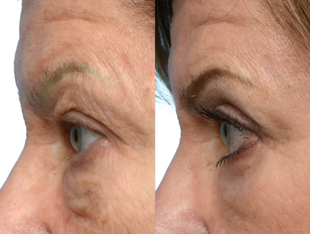 Blepharoplasty (Eyelid Surgery) Before & After Gallery - Patient 402903 - Image 2