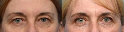 Blepharoplasty (Eyelid Surgery) Before & After Gallery - Patient 169649 - Image 1