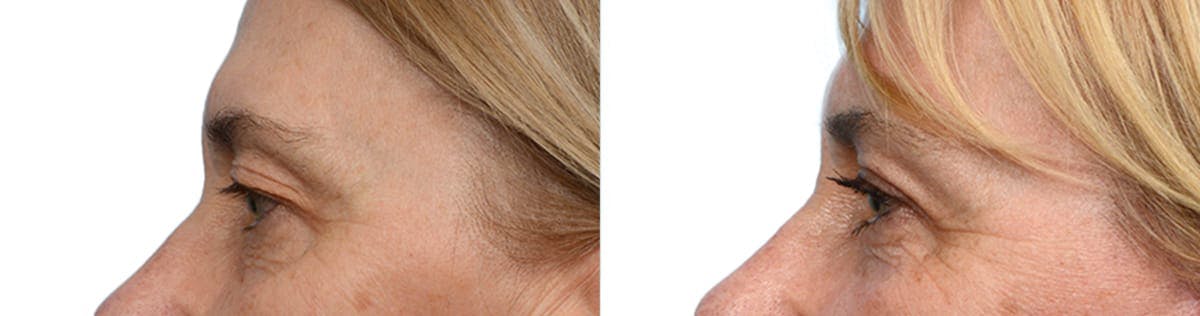Blepharoplasty (Eyelid Surgery) Before & After Gallery - Patient 169649 - Image 3