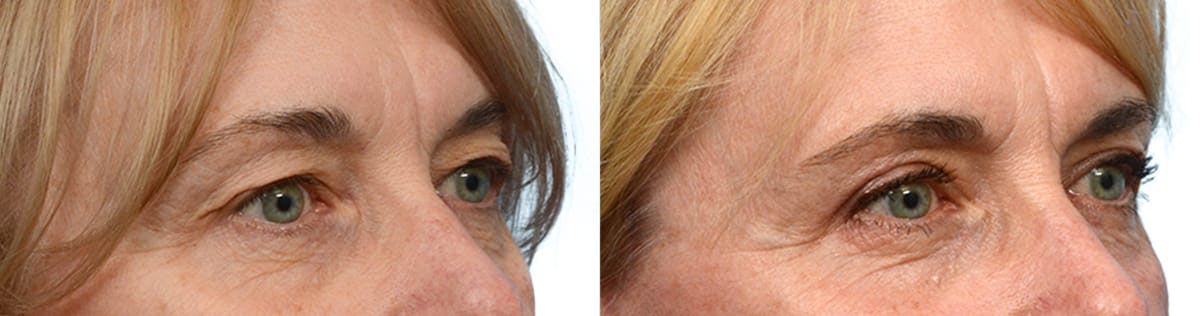 Blepharoplasty (Eyelid Surgery) Before & After Gallery - Patient 169649 - Image 4