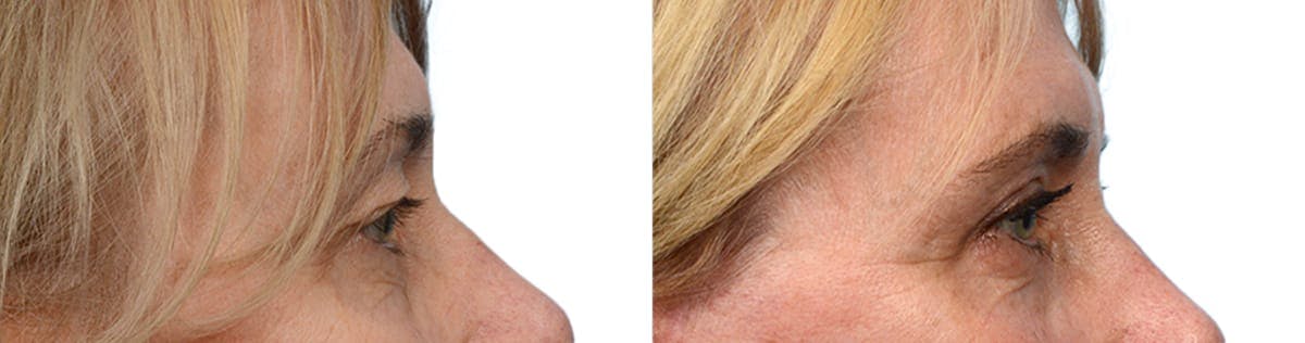 Blepharoplasty (Eyelid Surgery) Before & After Gallery - Patient 169649 - Image 5