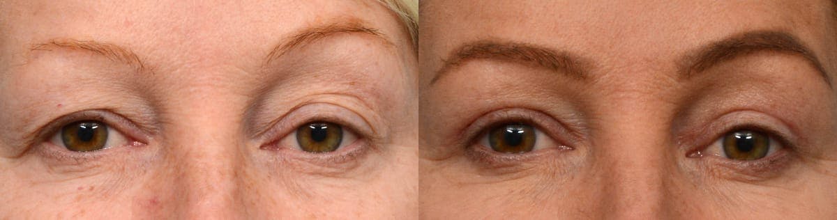 Blepharoplasty (Eyelid Surgery) Before & After Gallery - Patient 254816 - Image 1