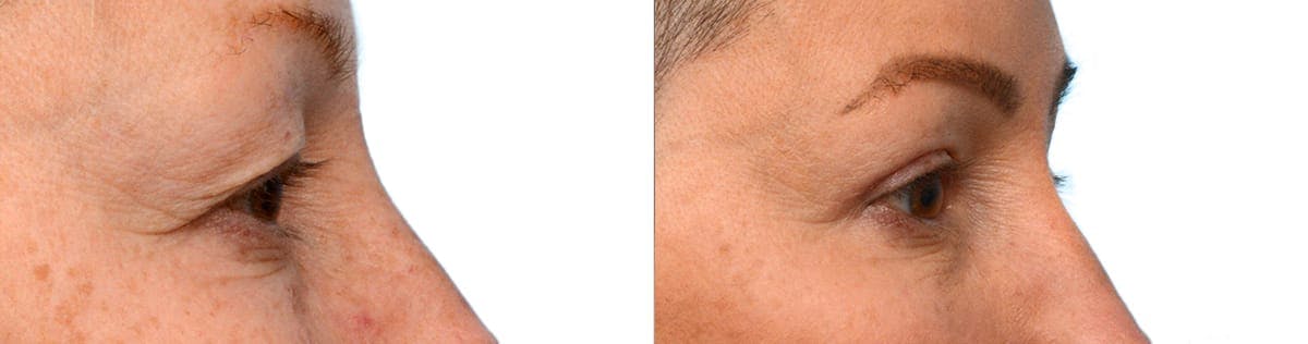 Blepharoplasty (Eyelid Surgery) Before & After Gallery - Patient 254816 - Image 2