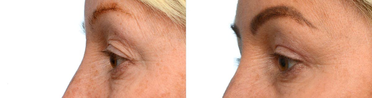 Blepharoplasty (Eyelid Surgery) Before & After Gallery - Patient 254816 - Image 3