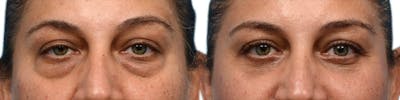 Blepharoplasty (Eyelid Surgery) Before & After Gallery - Patient 571323 - Image 1