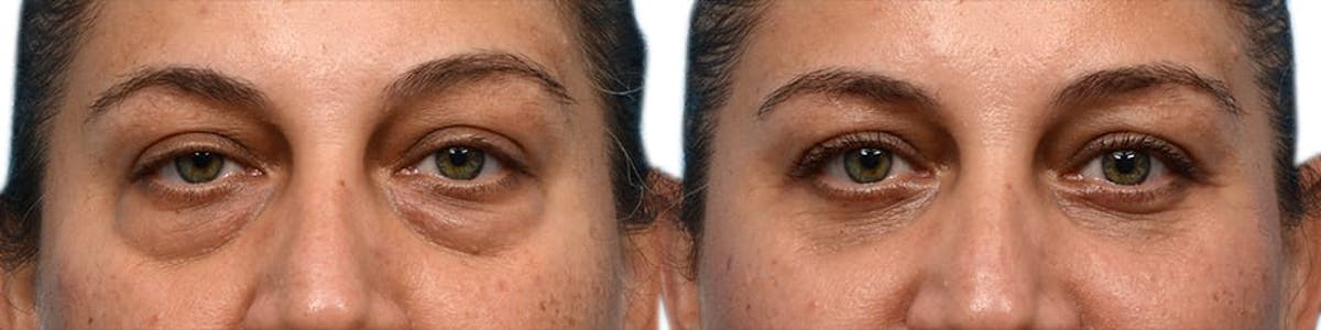 Blepharoplasty (Eyelid Surgery) Before & After Gallery - Patient 571323 - Image 1