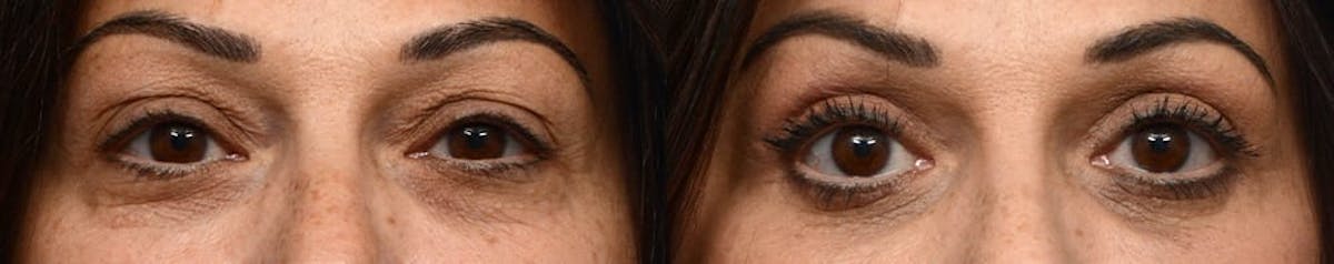 Blepharoplasty (Eyelid Surgery) Before & After Gallery - Patient 655461 - Image 1