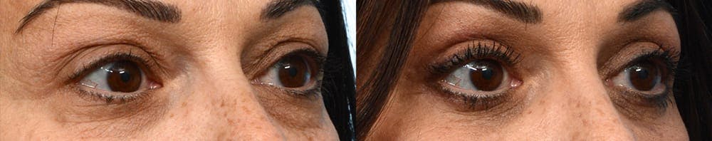 Blepharoplasty (Eyelid Surgery) Before & After Gallery - Patient 655461 - Image 2