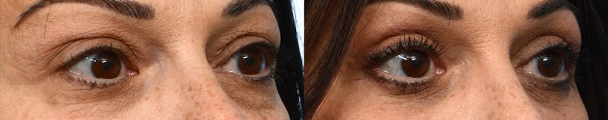 Blepharoplasty (Eyelid Surgery) Before & After Gallery - Patient 655461 - Image 2