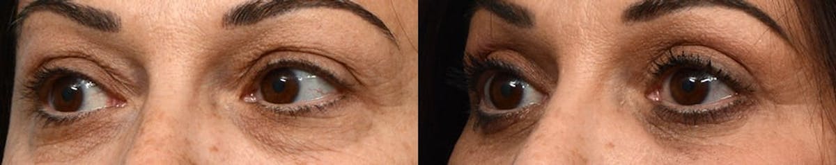 Blepharoplasty (Eyelid Surgery) Before & After Gallery - Patient 655461 - Image 3