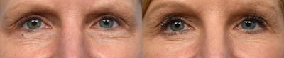Blepharoplasty (Eyelid Surgery) Before & After Gallery - Patient 132253 - Image 1