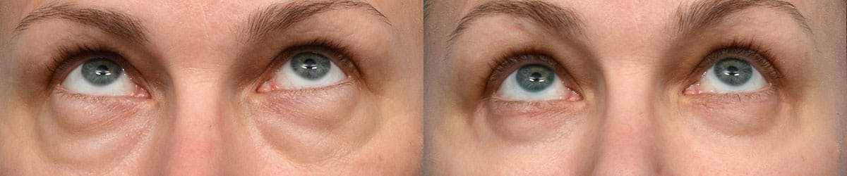 Blepharoplasty (Eyelid Surgery) Before & After Gallery - Patient 316159 - Image 2