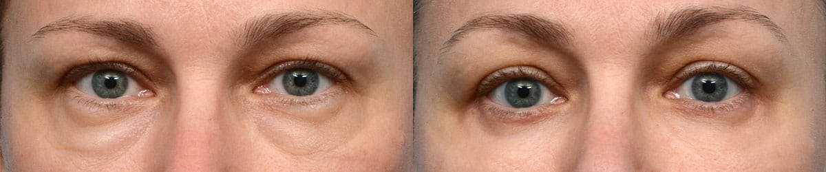 Blepharoplasty (Eyelid Surgery) Before & After Gallery - Patient 316159 - Image 1