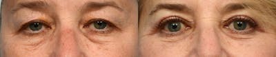 Blepharoplasty (Eyelid Surgery) Before & After Gallery - Patient 179028 - Image 1