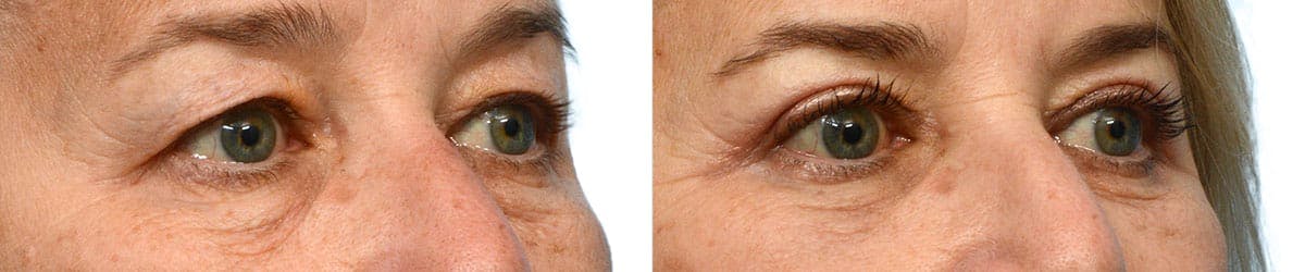Blepharoplasty (Eyelid Surgery) Before & After Gallery - Patient 179028 - Image 2