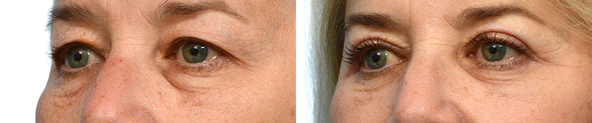 Blepharoplasty (Eyelid Surgery) Before & After Gallery - Patient 179028 - Image 3